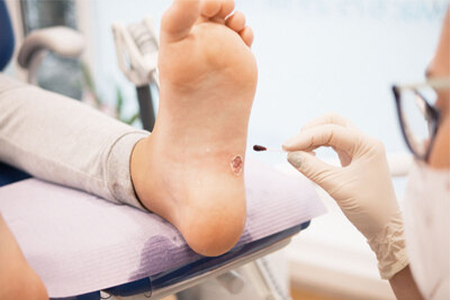 Photo of a chiropodist treating a verruca in a clinic